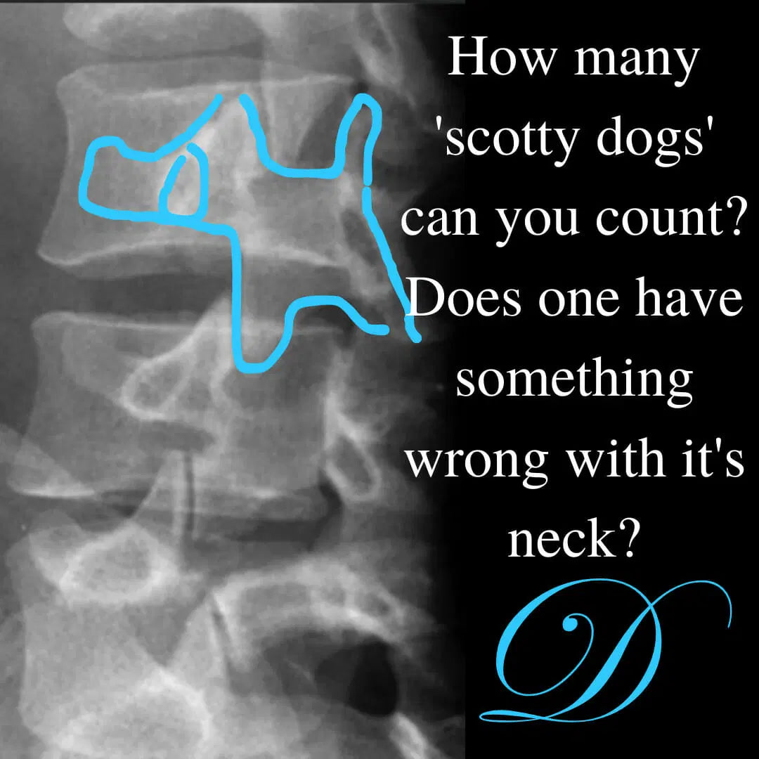 Understanding Lumbar Stress Fractures