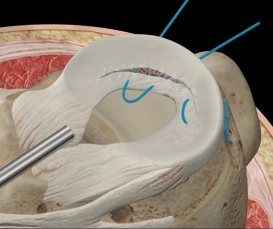 Life After Meniscal Repair
