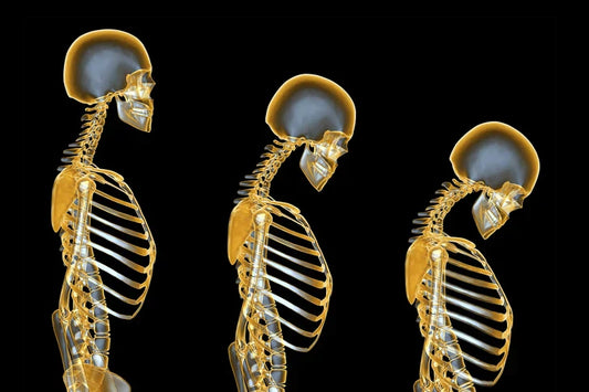 Reducing the Risk of Osteoporosis