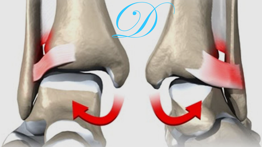 “When the Ankle Betrays You: Unravelling the Hidden Threat of Syndesmosis Injuries”