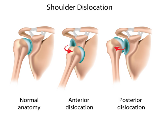 Understanding and Managing Anterior Shoulder Dislocations: A Comprehensive Guide to Recovery