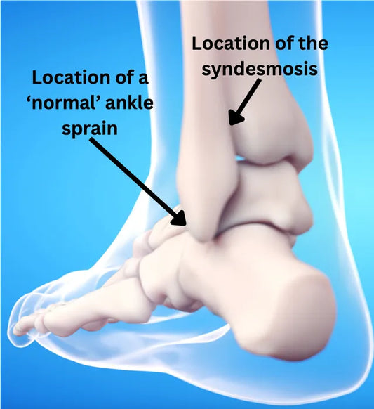 When the Ankle Betrays You: Unravelling the Hidden Threat of Syndesmosis Injuries